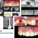 IMPrESS Perio Implant Center Dr. Noroozi Vancouver Periodontist Implant Specialist Burnaby BC