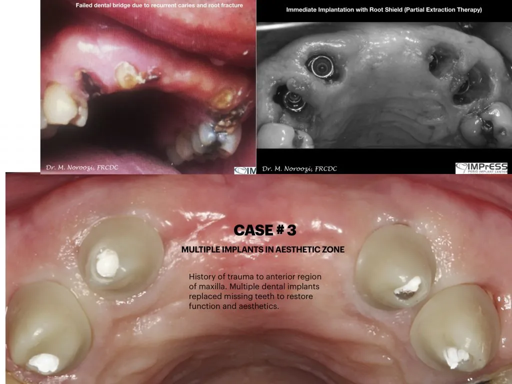 IMPrESS Perio Implant Center Dr. Noroozi Vancouver Periodontist Implant Specialist Burnaby BC