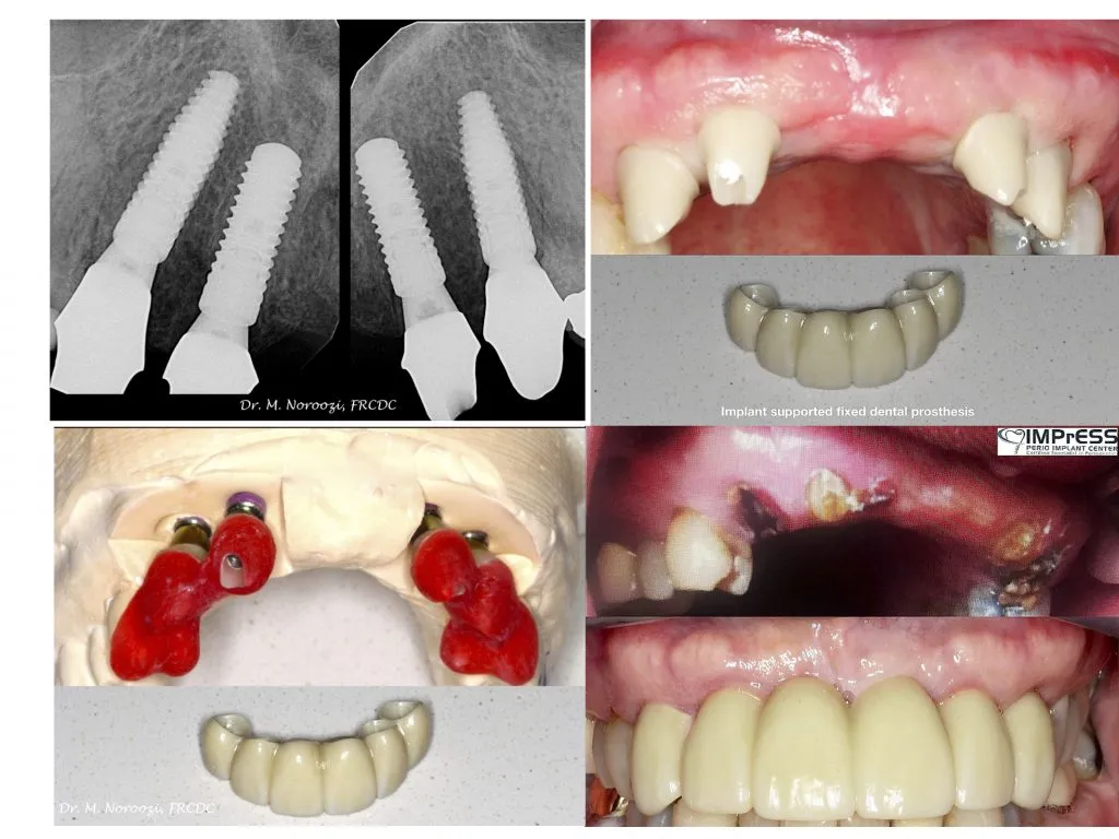 IMPrESS Perio Implant Center Dr. Noroozi Vancouver Periodontist Implant Specialist Burnaby BC