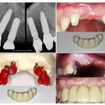 IMPrESS Perio Implant Center Dr. Noroozi Vancouver Periodontist Implant Specialist Burnaby BC