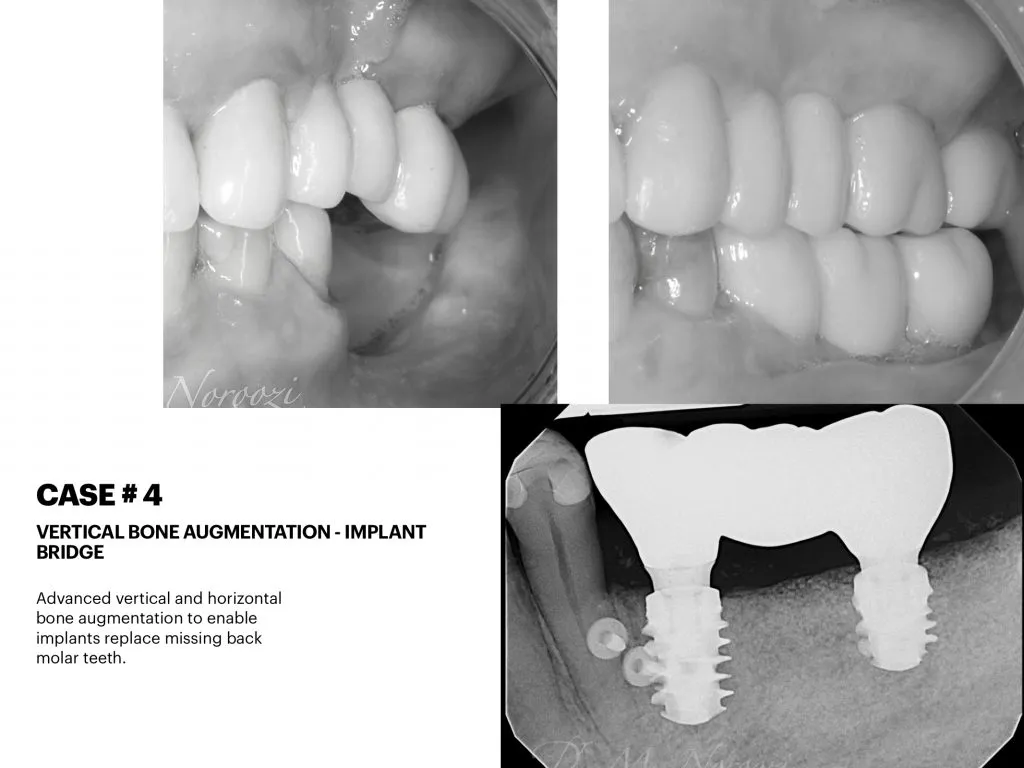 IMPrESS Perio Implant Center Dr. Noroozi Vancouver Periodontist Implant Specialist Burnaby BC
