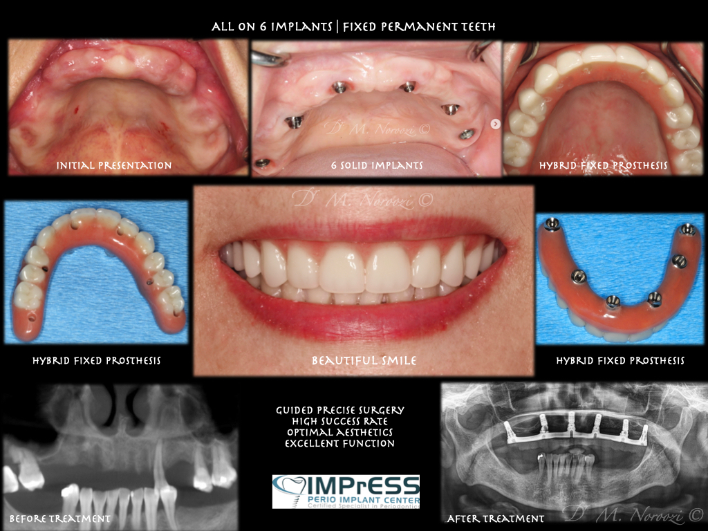 All on 4 All on 6 implants Teeth in a day Full Implant Denture IMPrESS Perio Implant Center Dr. Noroozi Vancouver Implant Specialist