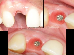 Dental-Implant-in-esthetic-zone-Bone-and-Gum-grafting-implant-surgery-and-Immediate-provisional-same-day-implant-followed-by-final-crown-Dr.-Noroozi-IMPrESS-Perio-Implant-Center-Vancouver-BC
