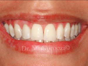 Dental-Implant-in-esthetic-zone-Bone-and-Gum-grafting-implant-surgery-and-Immediate-provisional-same-day-implant-followed-by-final-crown-Dr.-Noroozi-IMPrESS-Perio-Implant-Center-Vancouver-BC