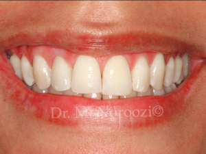 Dental-Implant-in-esthetic-zone-Bone-and-Gum-grafting-implant-surgery-and-Immediate-provisional-same-day-implant-followed-by-final-crown-Dr.-Noroozi-IMPrESS-Perio-Implant-Center-Vancouver-BC
