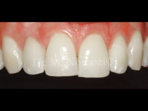 Dental-Implant-in-esthetic-zone-Bone-and-Gum-grafting-implant-surgery-and-Immediate-provisional-same-day-implant-followed-by-final-crown-Dr.-Noroozi-IMPrESS-Perio-Implant-Center-Vancouver-BC