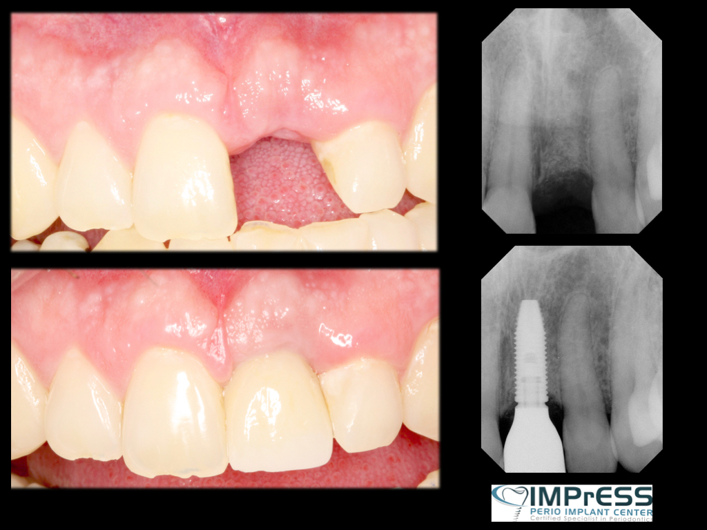 Front Missing Tooth Replacement with Dental Implant Dr. Noroozi Periodontist Implant Specialist Dentist IMPrESS Perio Implant Center Vancouver BC.001