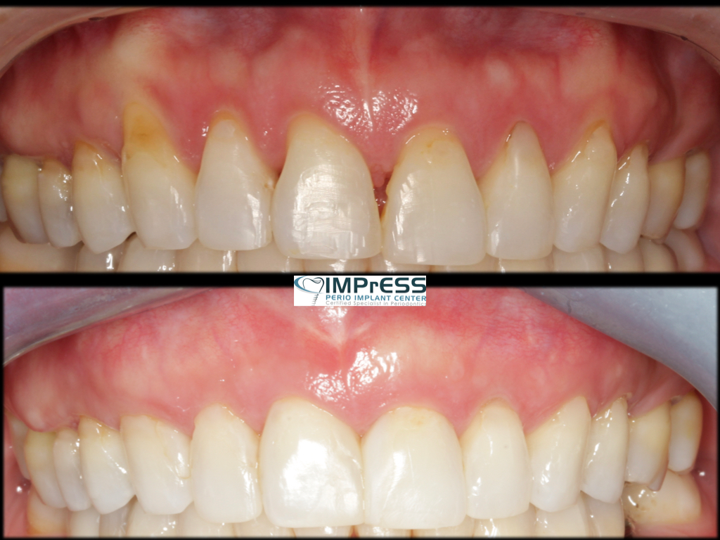 Gum Grafting for Gurm Recession Treatment IMPrESS Perio
