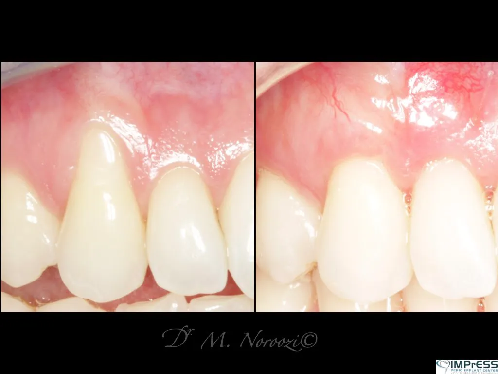 Gum Recession Treatment Gum Graft CTG Tunnel Dr. Noroozi Vancouver Periodontist Implant Specialist IMPrESS Perio Implant Center