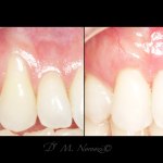 Gum Recession Treatment Gum Graft CTG Tunnel Dr. Noroozi Vancouver Periodontist Implant Specialist IMPrESS Perio Implant Center