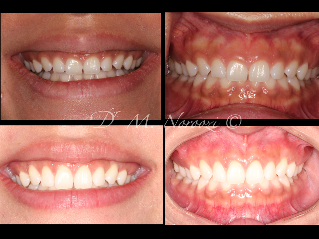 Esthetic Crown-Lengthening Gummy-Smile Treatment Dr. Noroozi Vancouver-Perioodntist IMPrESS-Perio Implant Center