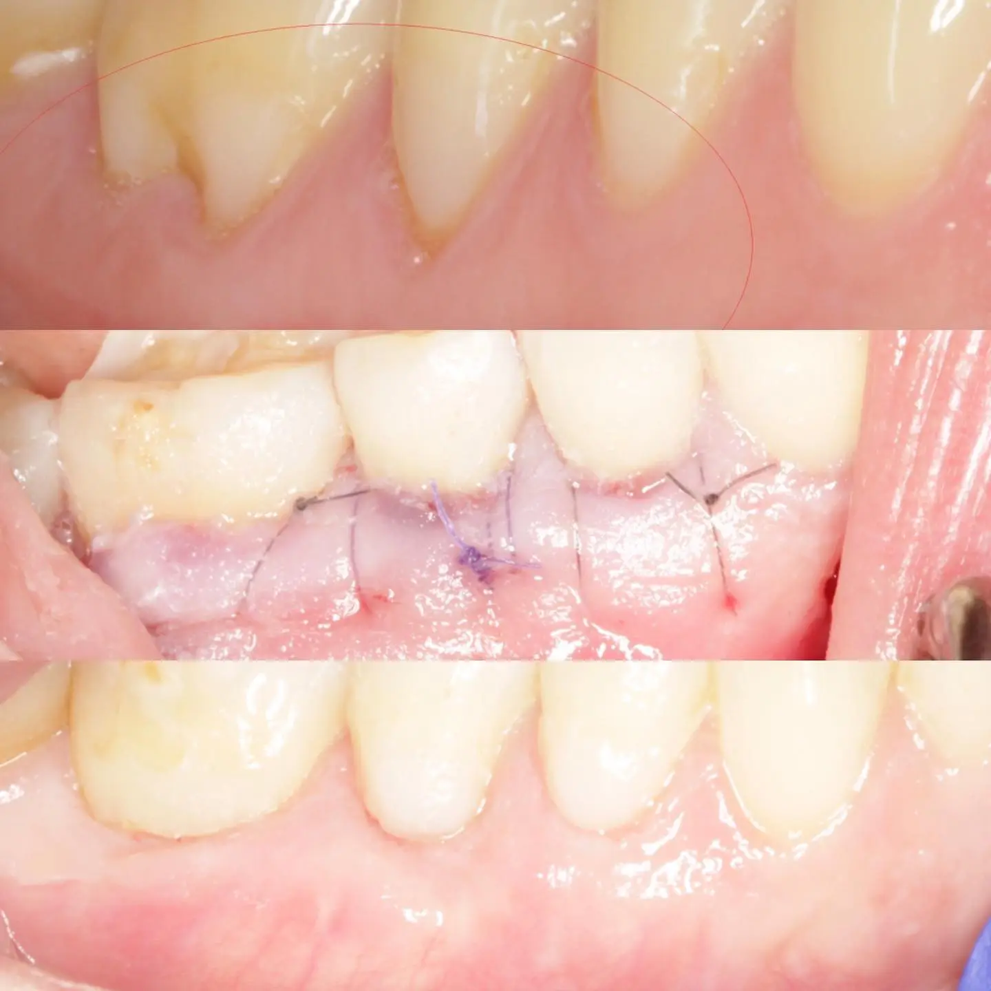 Pinhole Gum Rejuvenation Gum Recession Reversal Gum Grafting Alternative Dr. Noroozi Periodontist IMPrESS Perio Implant Center.jpg