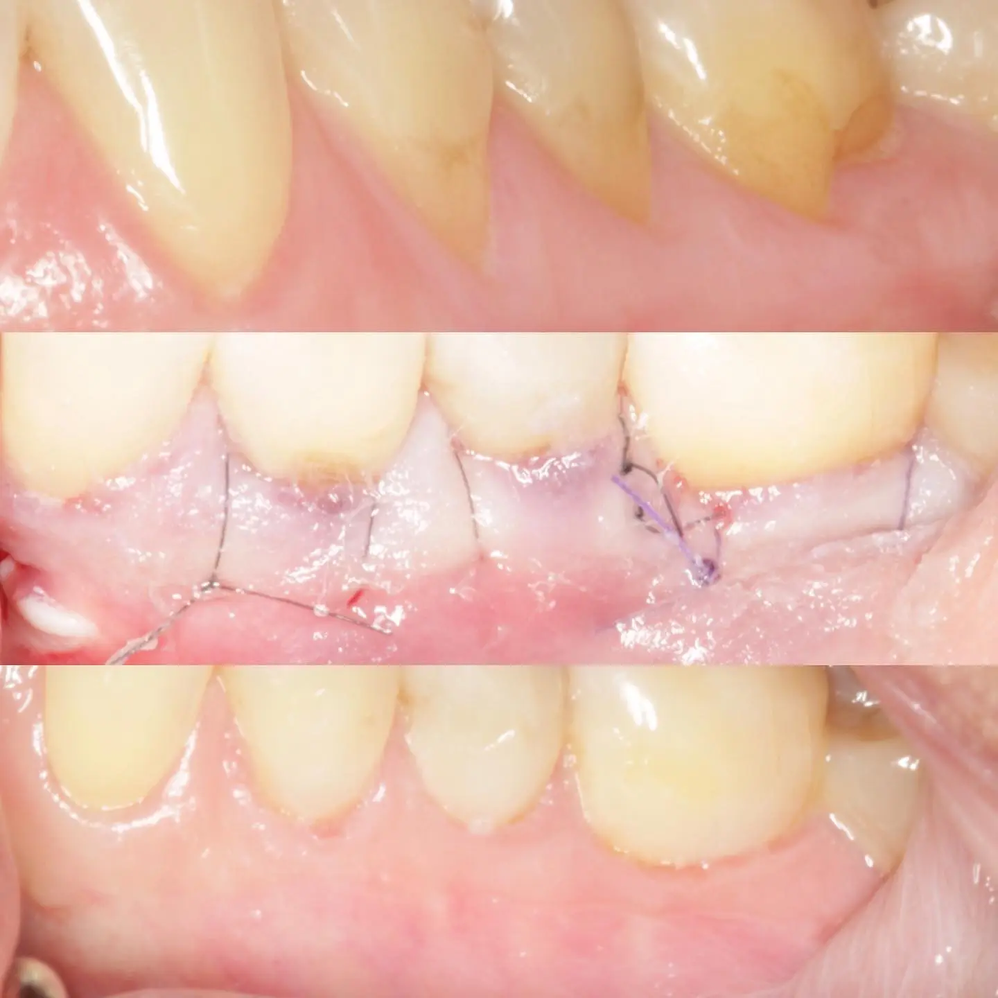 Pinhole Gum Rejuvenation Gum Recession Reversal Gum Grafting Alternative Dr. Noroozi Periodontist IMPrESS Perio Implant Center.jpg