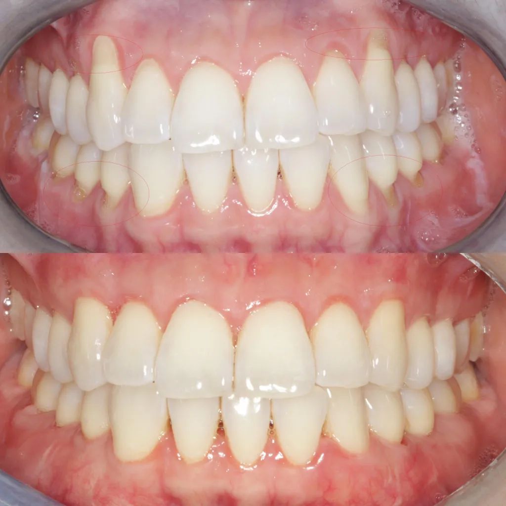 Pinhole Surgical Technique with Allograft Dermal TIssue Gum Graft Alternative for Gum Recession Treatment Dr. Noroozi IMPrESS Perio Implant Center