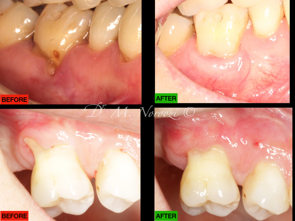 Gum Grafting for Treatment of Gum Recession Dr. Noroozi Periodontist Burnaby Vancouver IMPrESS Perio Implant Center