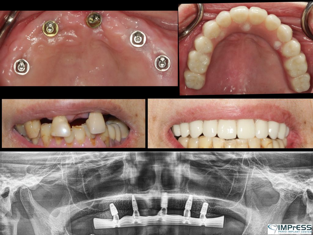 Best All on X Full Mouth Implants All On 4 Vancouver Dental Implants Dr. Noroozi IMPrESS Perio Implant Center Implant Specialist