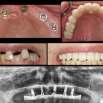 Best All on X Full Mouth Implants All On 4 Vancouver Dental Implants Dr. Noroozi IMPrESS Perio Implant Center Implant Specialist
