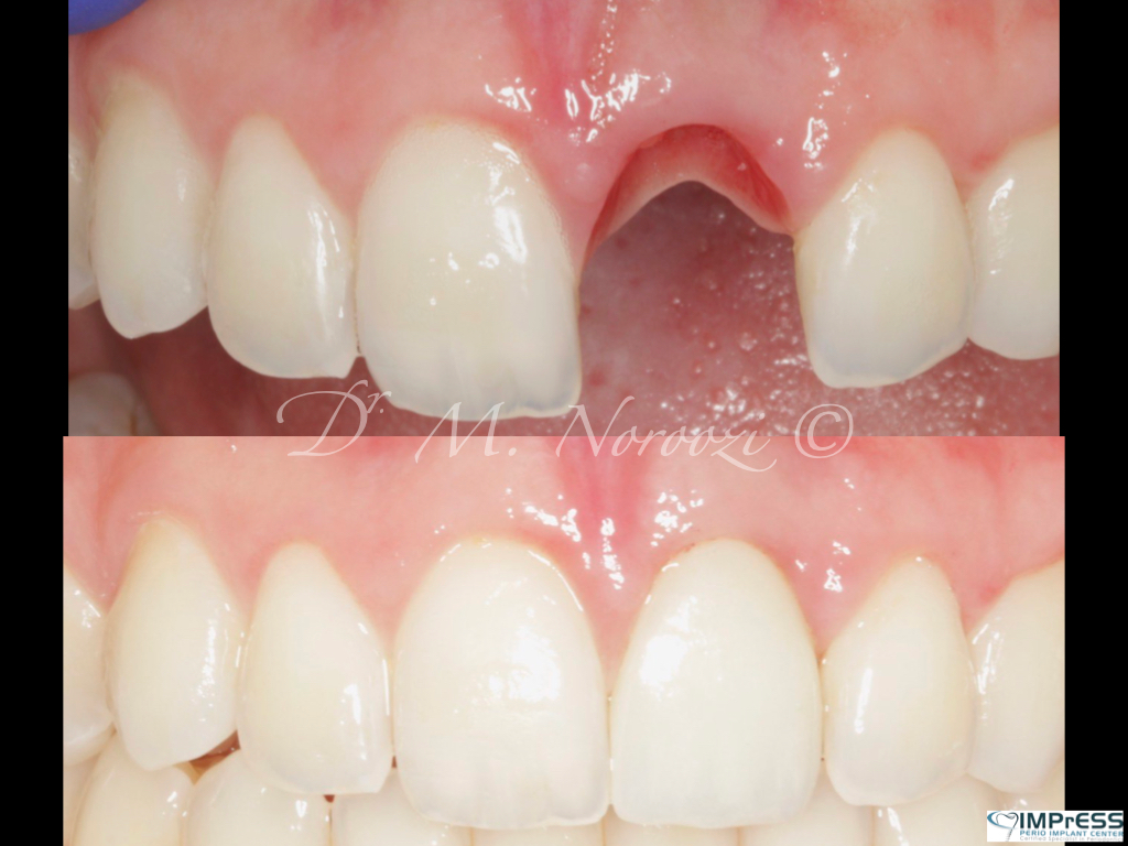 Dental Implant Specialist Dr. Noroozi IMPrESS Perio Implant Center Vancouver BC Implant Centre Periodontist