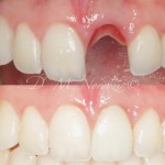 Dental Implant Specialist Dr. Noroozi IMPrESS Perio Implant Center Vancouver BC Implant Centre Periodontist