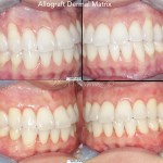 Pinhole Gum Rejuvenation Dr. Noroozi Vancouver Burnaby Periodontist IMPrESS Perio Implant Center Gum Grafting Alternative