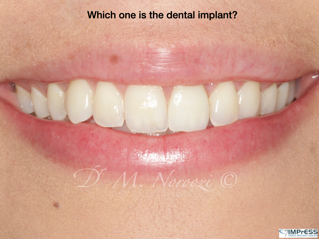 Same Day Implants Dental Implant Specialist Dr. Noroozi IMPrESS Perio Implant Center Vancouver BC Implant Centre Periodontist
