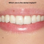 Same Day Implants Dental Implant Specialist Dr. Noroozi IMPrESS Perio Implant Center Vancouver BC Implant Centre Periodontist