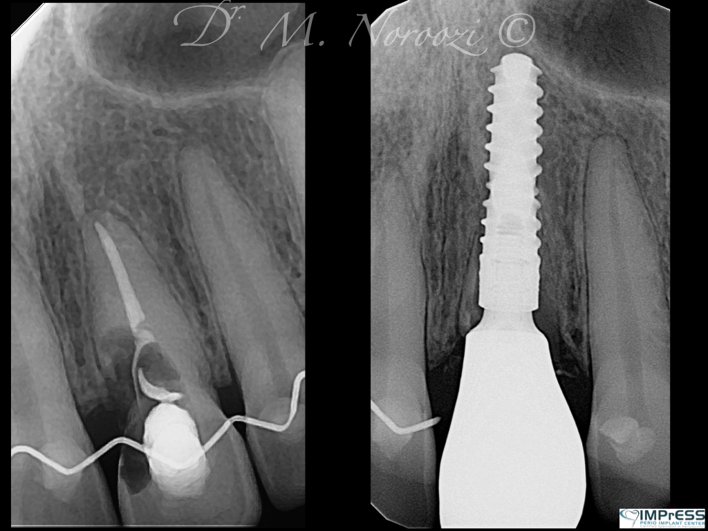 Dental Implant Specialist Dr. Noroozi IMPrESS Perio Implant Center Vancouver BC Implant Centre Periodontist