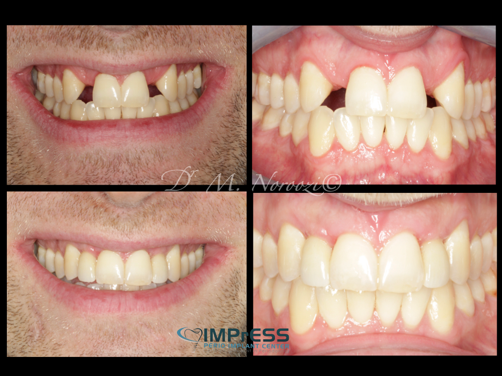 Congenitally Missing Lateral Incisors Dr. M. Noroozi IMPrESS Perio Implant Center Vancouver Burnaby Periodontist Implant Specialist
