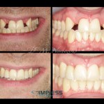 Congenitally Missing Lateral Incisors Dr. M. Noroozi IMPrESS Perio Implant Center Vancouver Burnaby Periodontist Implant Specialist