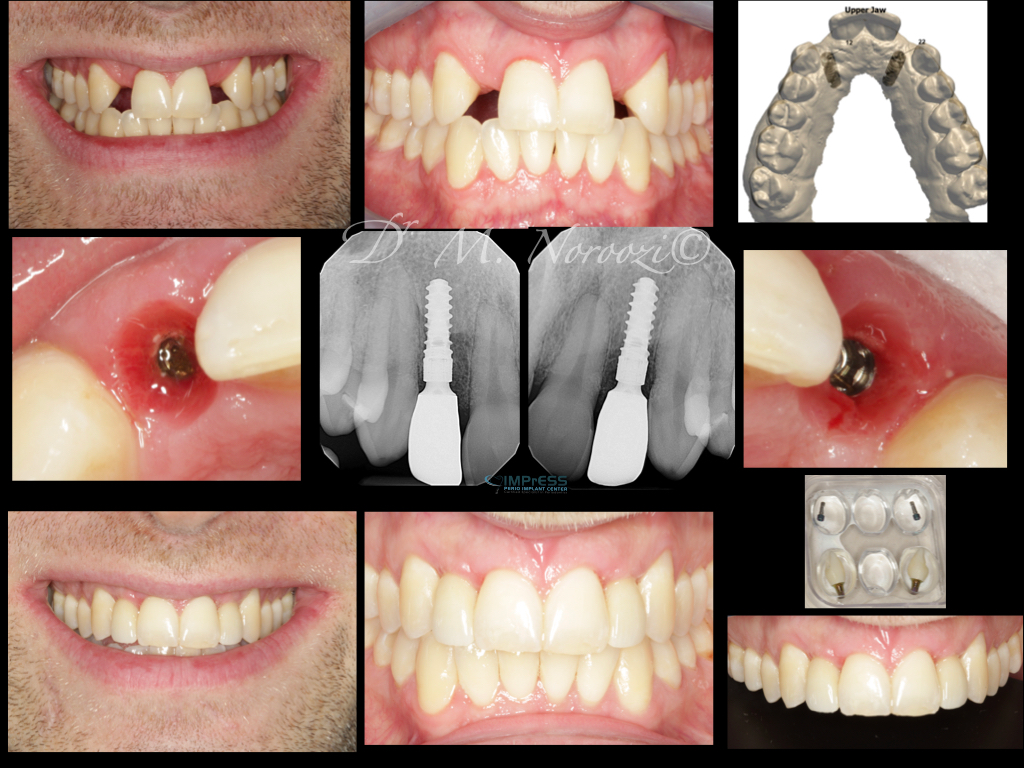 Congenitally Missing Lateral Incisors Dr. M. Noroozi IMPrESS Perio Implant Center Vancouver Burnaby Periodontist