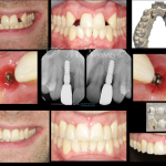 Congenitally Missing Lateral Incisors Dr. M. Noroozi IMPrESS Perio Implant Center Vancouver Burnaby Periodontist