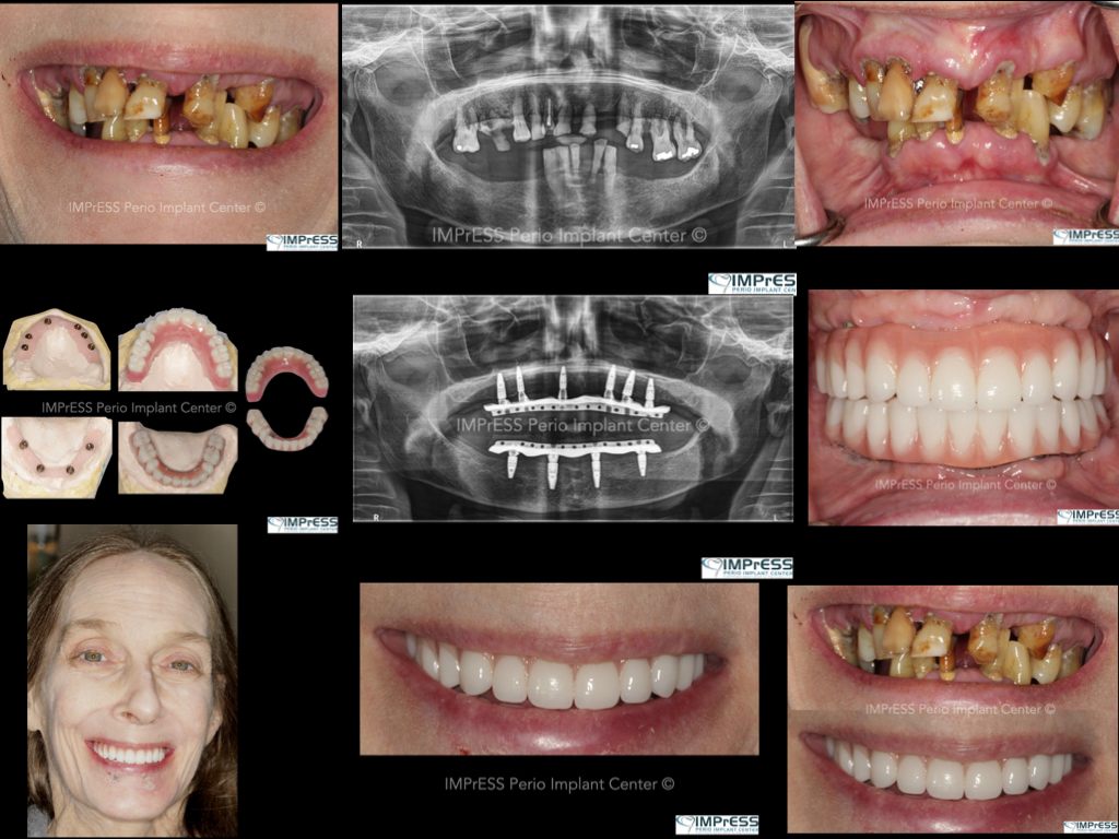 All on X implant Full Mouth Implant Reconstruction All on 4 Implants IMPrESS Perio Implant Center Vancouver Burnaby Periodontist Prosthodontist Implant Specialist Dr. Noroozi Periodontist Implant Specialist