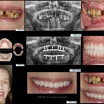 All on X implant Full Mouth Implant Reconstruction All on 4 Implants IMPrESS Perio Implant Center Vancouver Burnaby Periodontist Prosthodontist Implant Specialist Dr. Noroozi Periodontist Implant Specialist