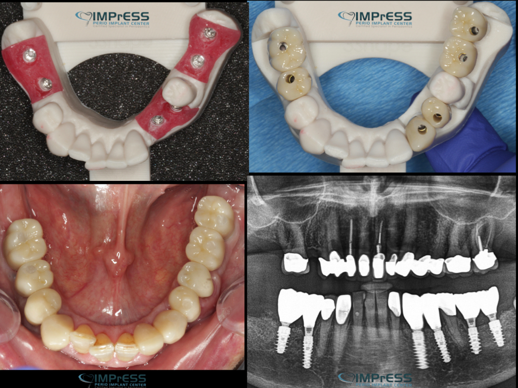 Multiple Dental Implants IMPrESS Perio Implant Center Burnaby Implant Specialist Vancouver Implant Center Dr. Mehdi Noroozi Implant Specialist in BC