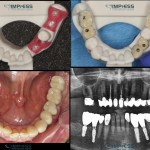 Multiple Dental Implants IMPrESS Perio Implant Center Burnaby Implant Specialist Vancouver Implant Center Dr. Mehdi Noroozi Implant Specialist in BC
