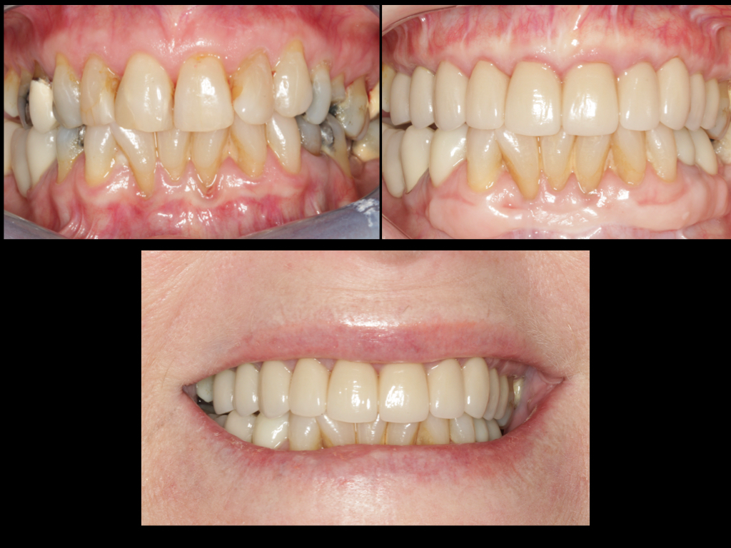 full mouth crowns