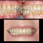 full mouth crowns