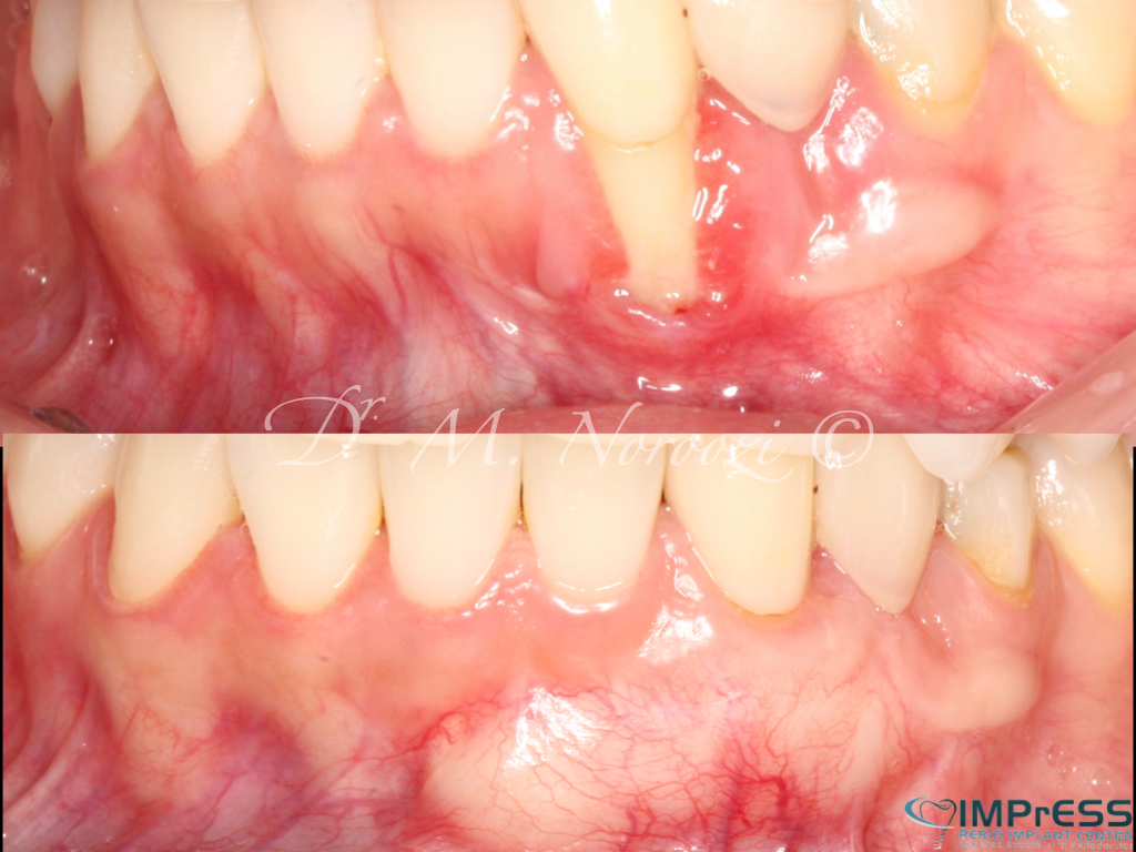 Gum Graft Surgery in Burnaby BC, Dr. Noroozi periodontist Vancouver BC IMPrESS Perio Implant Center.005