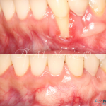 Gum Graft Surgery in Burnaby BC, Dr. Noroozi periodontist Vancouver BC IMPrESS Perio Implant Center.005