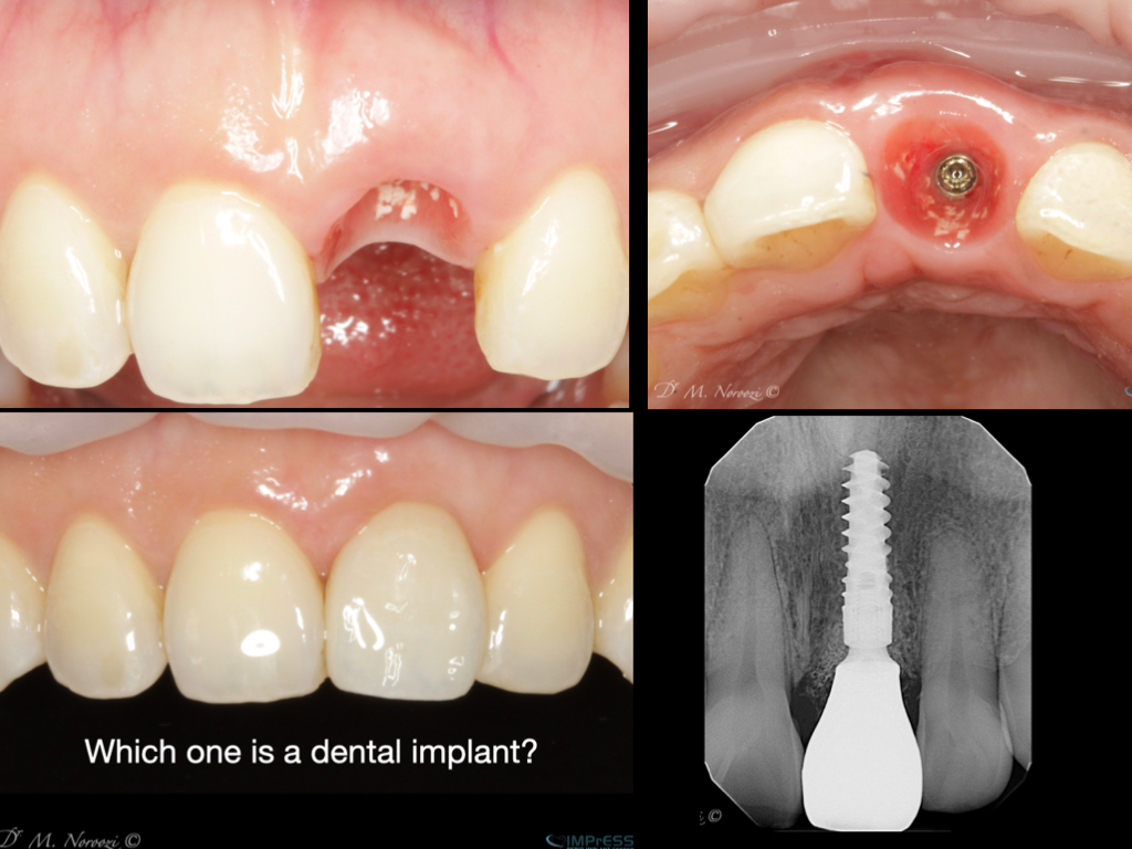 Front Implant Tooth, best dental implants in Burnaby BC Vancouver BC IMPrESS Perio Implant Center