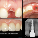 Front Implant Tooth, best dental implants in Burnaby BC Vancouver BC IMPrESS Perio Implant Center