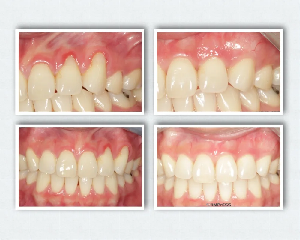 Gum Grafting for Gum Recession Treatment Gingival Graft Dr. Noroozi Vancouver Burnaby Periodontist Gum Specialist