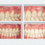 Gum Grafting for Gum Recession Treatment Gingival Graft Dr. Noroozi Vancouver Burnaby Periodontist Gum Specialist
