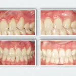 Gum Grafting for Gum Recession Treatment Gingival Graft Dr. Noroozi Vancouver Burnaby Periodontist Gum Specialist
