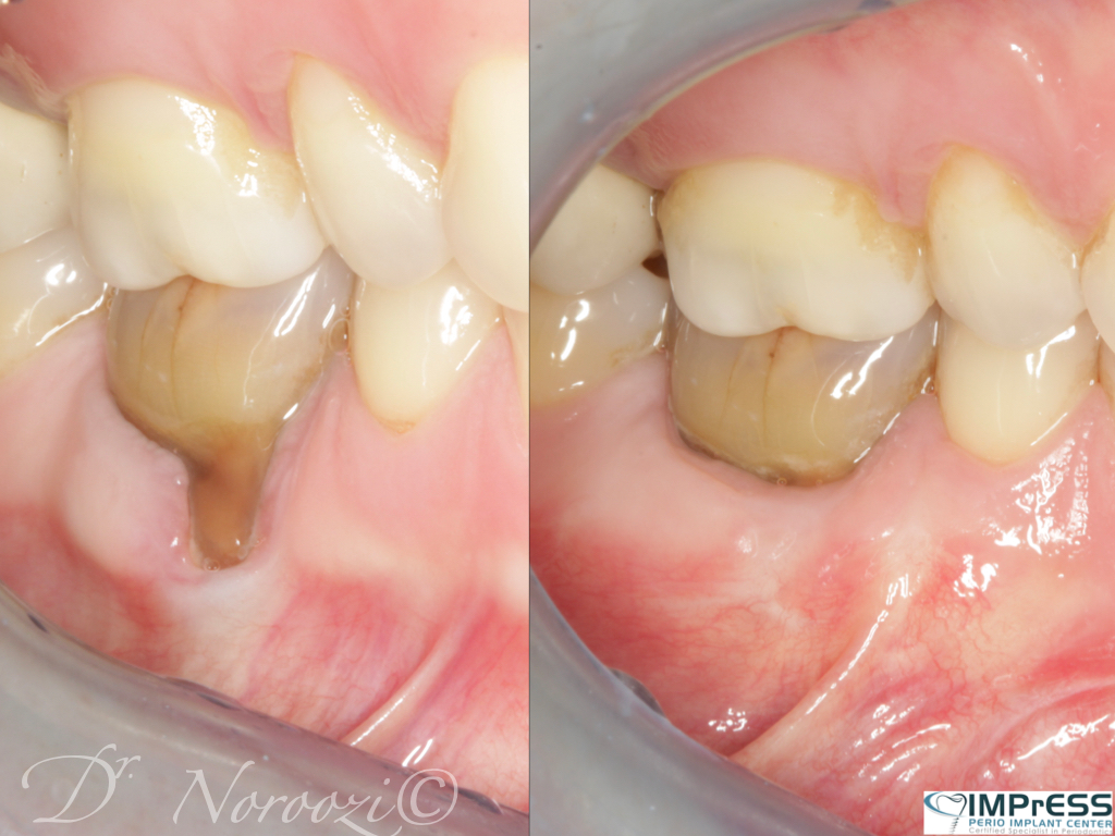 Gum Recession Treatment Gum Grafting Vancouver Gum Specialist IMPrESS Perio Implant Center