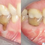 Gum Recession Treatment Gum Grafting Vancouver Gum Specialist IMPrESS Perio Implant Center