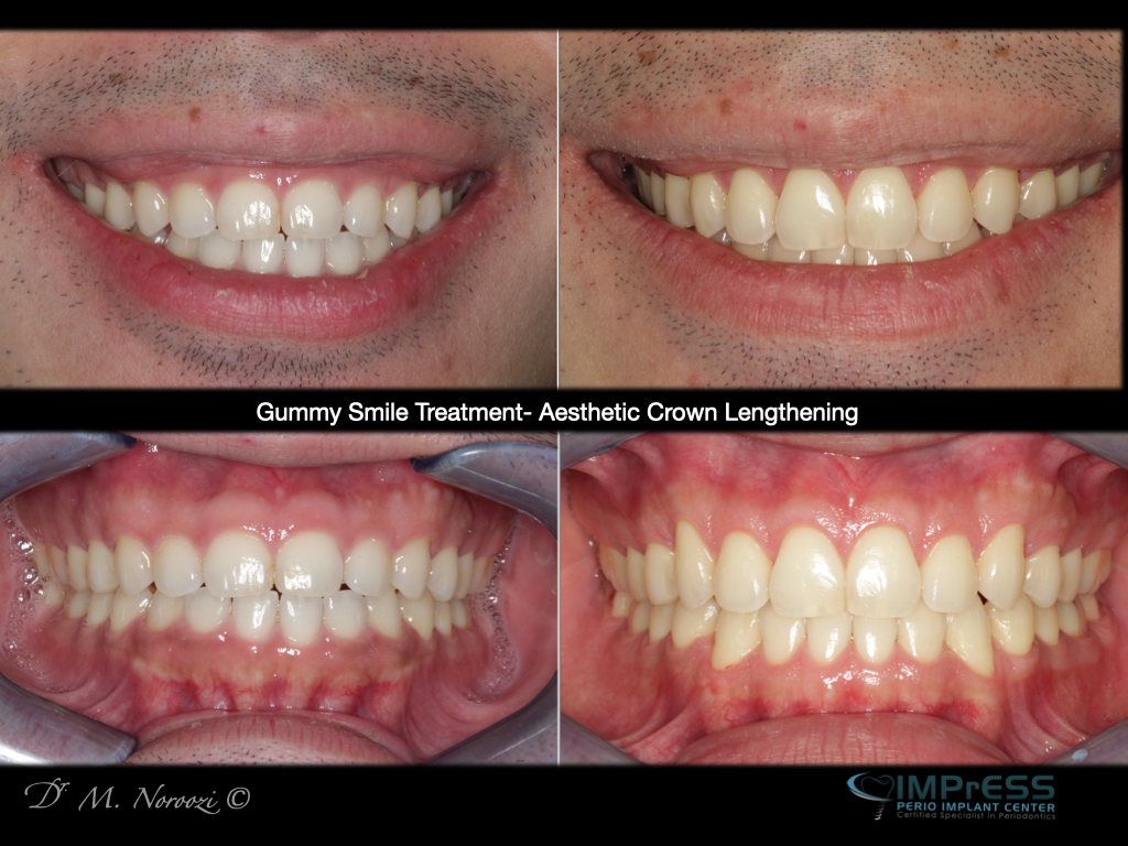 Gummy Smile Treatment Burnaby Vancouver BC, Dr. Noroozi Periodontist Gum Specialist, Aesthetic Crown Lengthening