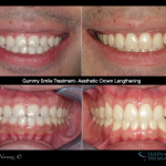 Gummy Smile Treatment Burnaby Vancouver BC, Dr. Noroozi Periodontist Gum Specialist, Aesthetic Crown Lengthening