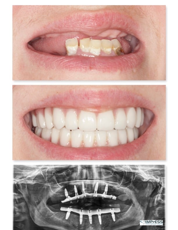 Full Mouth Implants IMPrESS Perio Implant Center Burnaby Vancouver BC Dr. Noroozi All On 4 Implants
