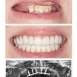 Full Mouth Implants IMPrESS Perio Implant Center Burnaby Vancouver BC Dr. Noroozi All On 4 Implants